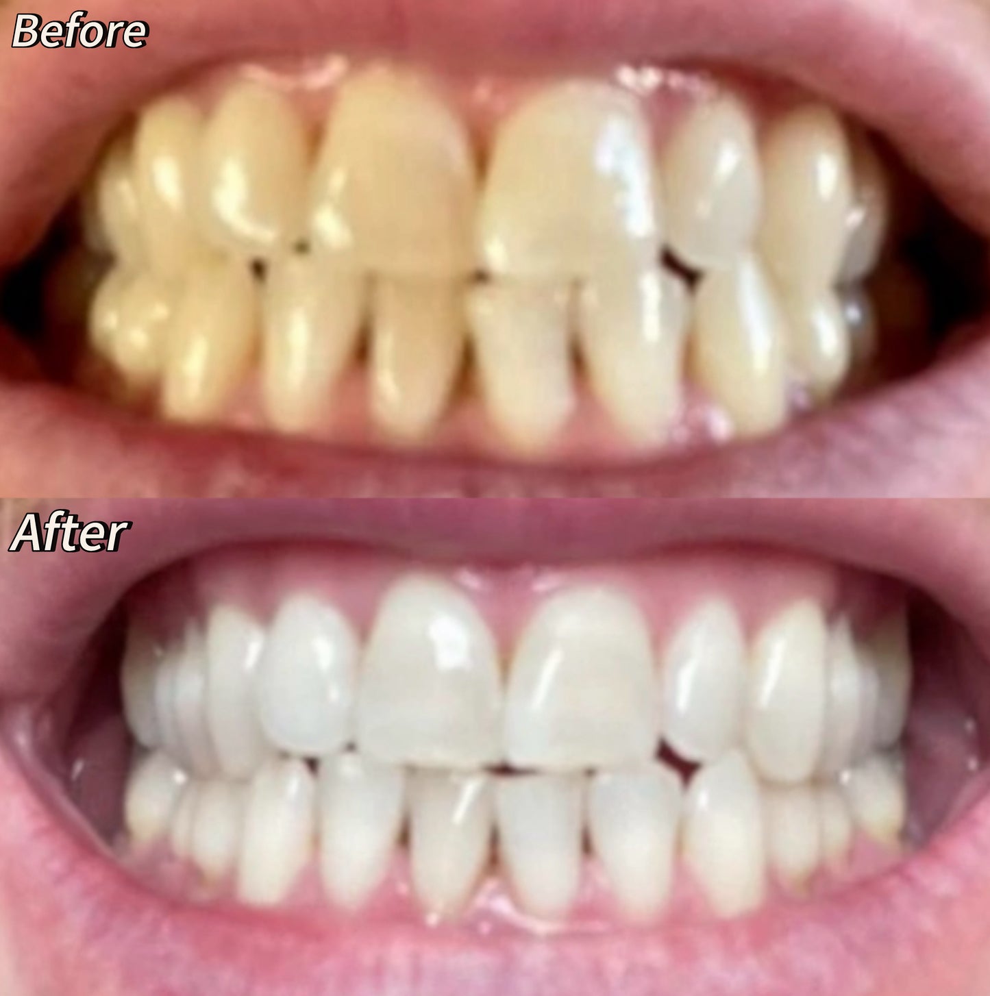 56 Teeth Whitening Strips • BUNDLE SAVER