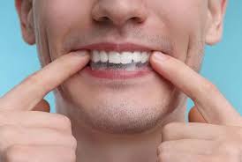 Are Teeth Whitening Strips Safe? The Truth Behind the Smile
