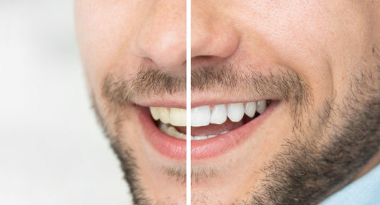 teeth whitening, teeth whitening strips at home use, at home teeth whitening products, at home teeth whitening kit