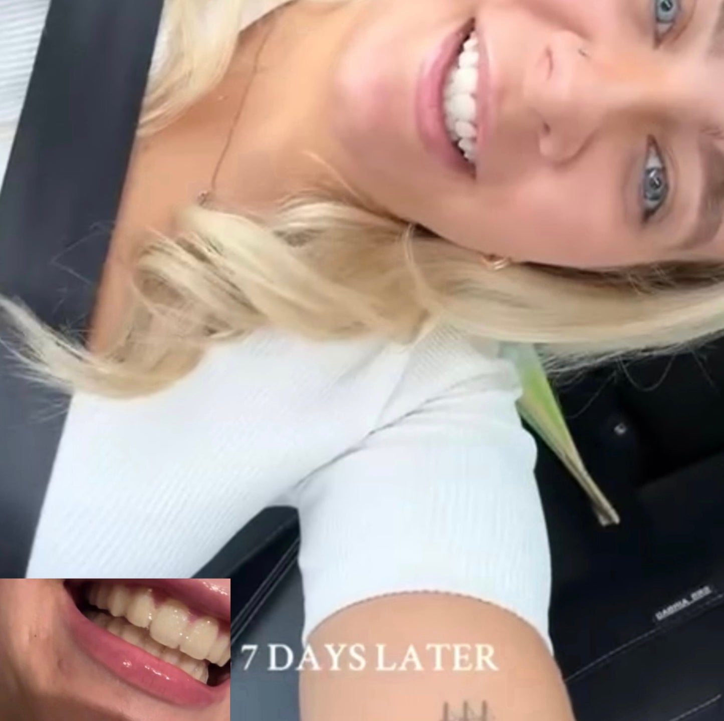 28 Teeth Whitening Strips