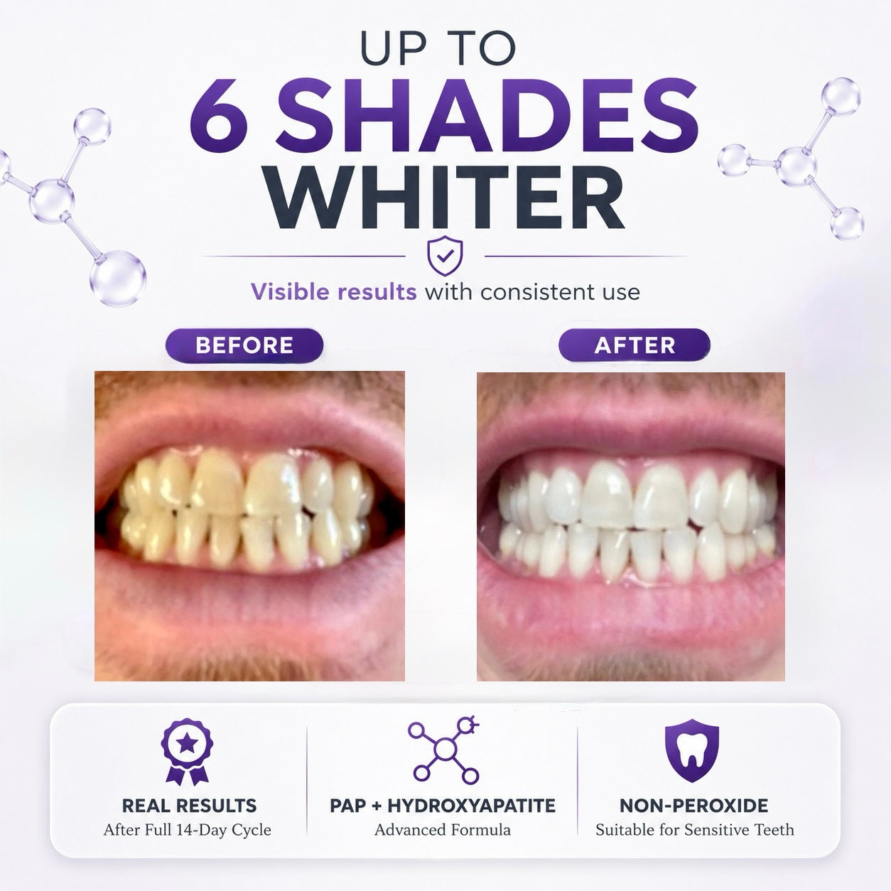 Pure Glow Teeth whitening before and after comparison using there PAP+ Hydroxyapatite whitening strips.