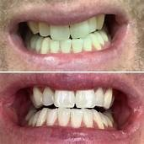 Dramatic before and after results using PureGlow PAP Advanced Teeth Whitening Strips, peroxide-free and sensitivity-free whitening solution, visible teeth whitening transformation, No-Slip Grip technology, 14-day treatment for enamel-safe, at-home whitening for sensitive teeth