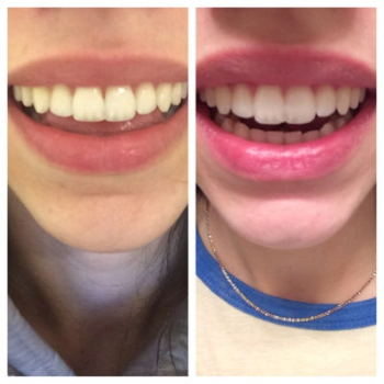 Before and after results using PureGlow PAP Advanced Teeth Whitening Strips, peroxide-free and sensitivity-free teeth whitening solution, visible whitening difference, No-Slip Grip technology, 14-day treatment, enamel-safe at-home teeth whitening for brighter smile