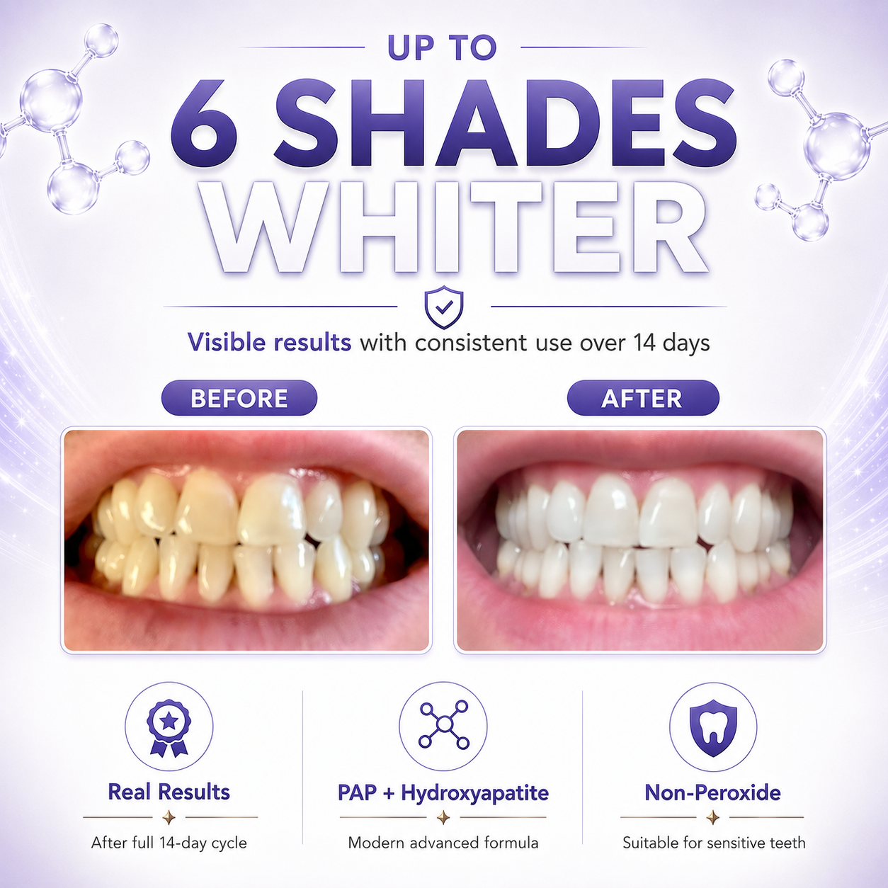 Before and after teeth whitening strips results using Pure Glow PAP whitening strips, showing visibly whiter teeth after a full 14-day cycle.