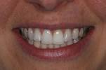 Bright white teeth after using PureGlow PAP Advanced Teeth Whitening Strips, peroxide-free, sensitivity-free teeth whitening, 14-day treatment, visible whitening results, No-Slip Grip technology, enamel-safe, at-home teeth whitening solution